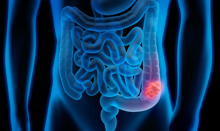ColorectalCancer