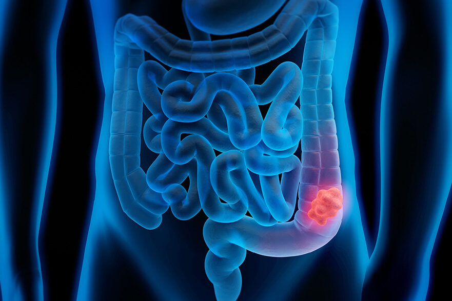 ColorectalCancer
