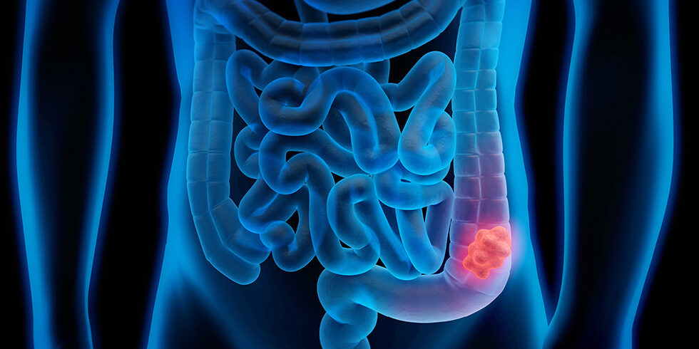 ColorectalCancer